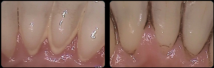 Mild tartar scale with mild gum inflamation