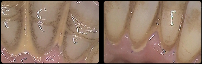Mild tartar scale with mild gum inflamation
