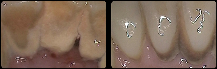 Severe staining, tartar and gum inflamation