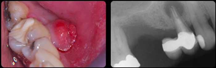 Root Fillings at Aura Dental